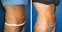 Before & After Photos